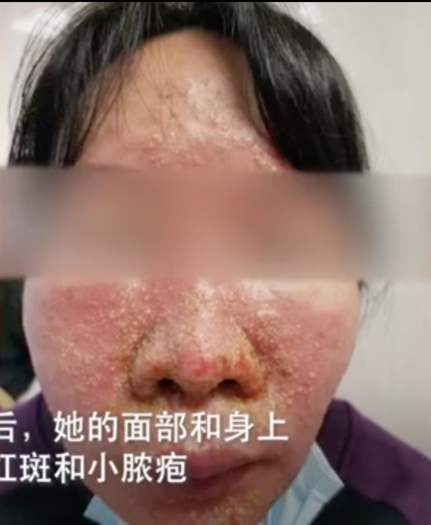 女子混吃7种感冒止咳药,全身长满脓疱!医生提醒→