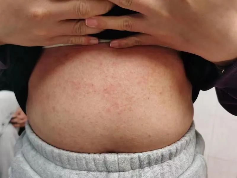 女子混吃7种感冒止咳药,全身长满脓疱!医生提醒→