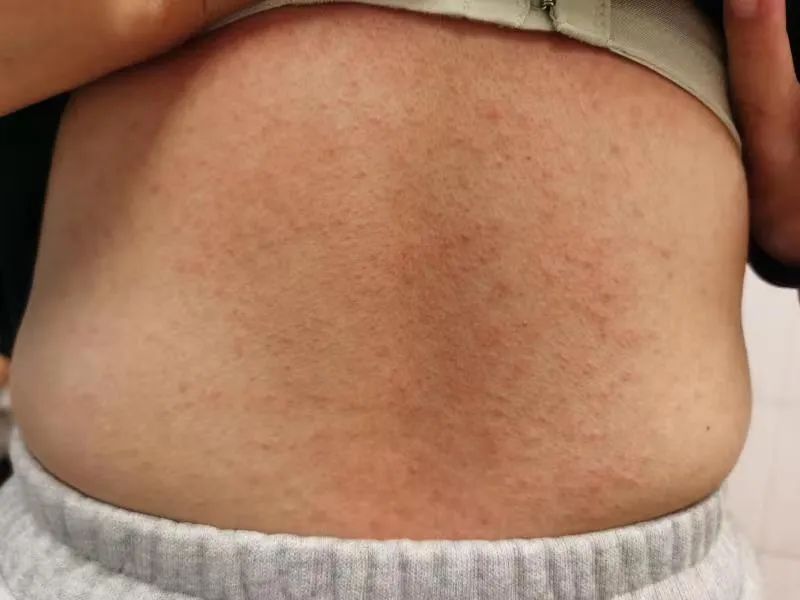 女子混吃7种感冒止咳药,全身长满脓疱!医生提醒→